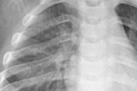 Швидке виявлення хламідії pneumoniae: надійне та ефективне